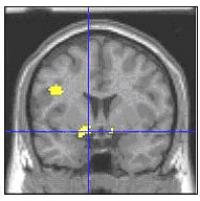 Youth with bipolar disorder misread facial expressions as hostile