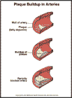 Patients with Peripheral Artery Disease are Under Treated